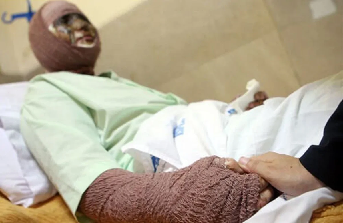 وقوع سالانه 300هزار مورد سوختگی/ تخت سوختگی استاندارد دولتی نداریم