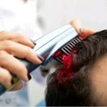 تاثیرات لیزر بعد از کاشت مو چگونه است؟