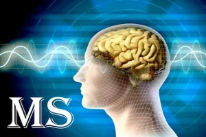 افزایش بیماران ام اس در اصفهان/ بحران هزینه درمان و کمبود حمایت