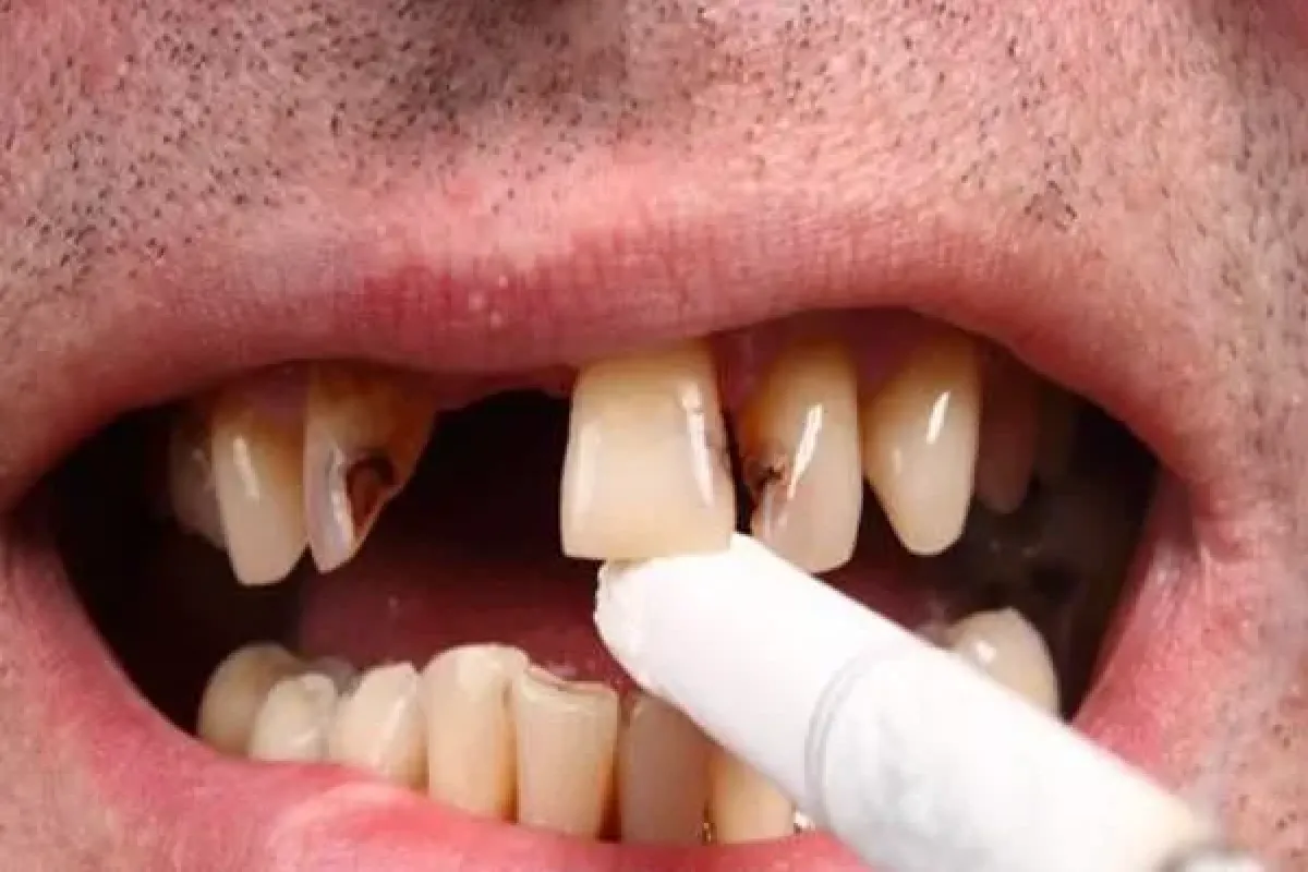 افراد سیگاری چهار برابر بیشتر از سایر افراد در معرض پوسیدگی دندان هستند