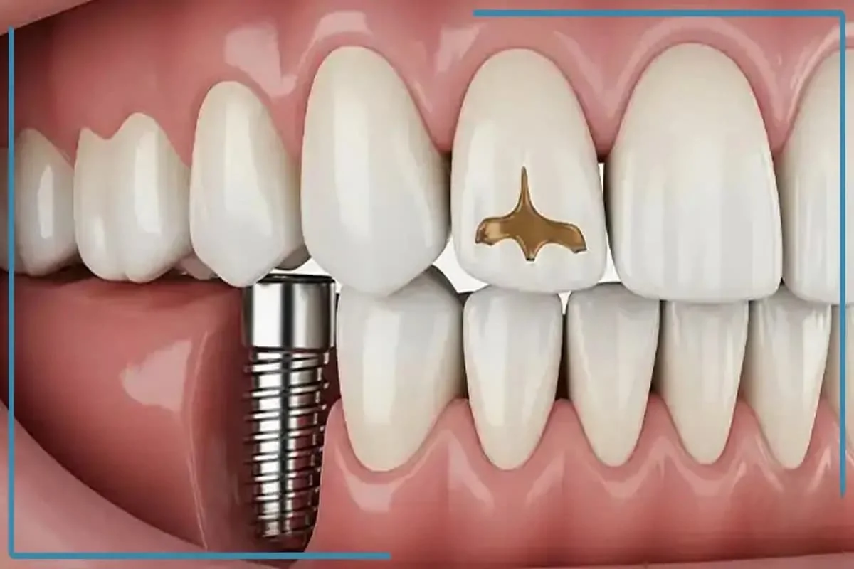 درست یا غلط بودن ایمپلنت فوری/ ممنوعیت تبلیغ پزشکی توسط سلبریتی‌ها